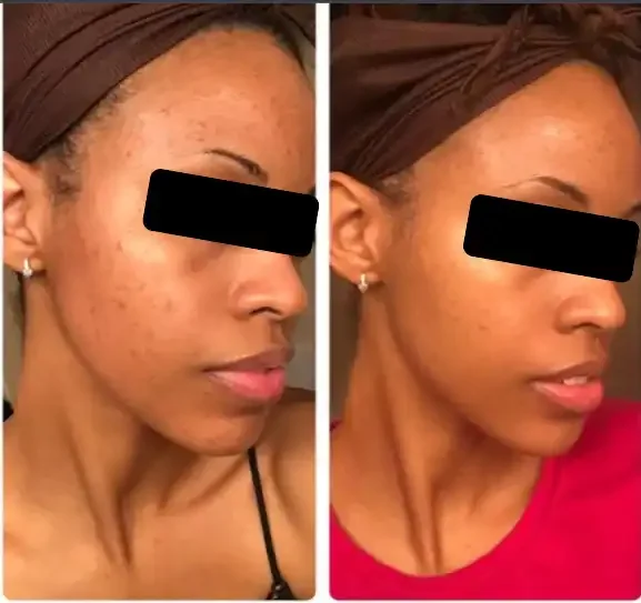 Side-by-side photos of a woman showing her face before and after skincare treatment, with visible improvements in skin clarity and tone.