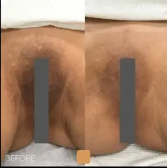 Close-up of a person's buttocks before and after treatment, showing changes in skin texture and appearance.