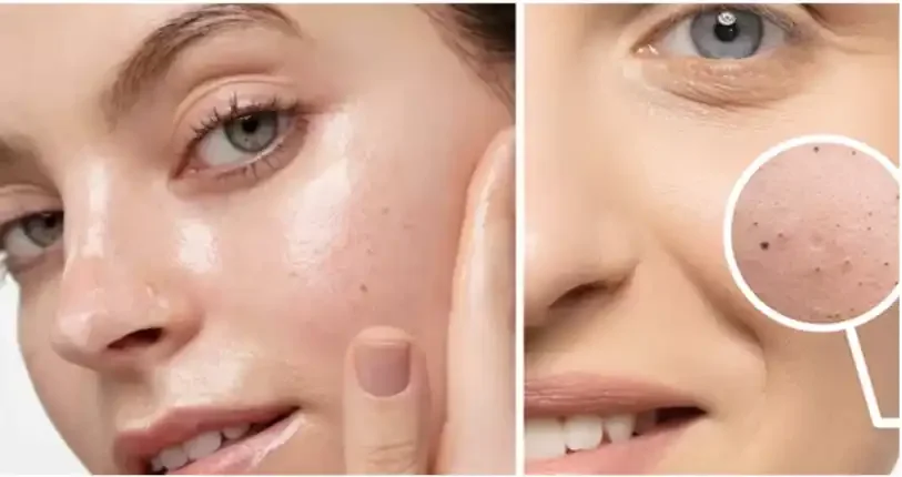 Close-up of a person's face highlighting skin and pores, with a magnified inset showing enlarged pores on the cheek.