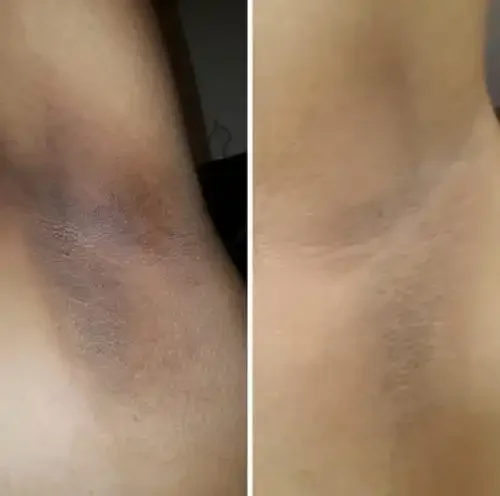 Close-up of a person's armpit showing before and after skin treatment.