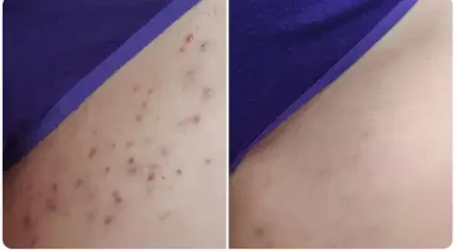 Side-by-side comparison of skin with acne scars before and after treatment, showing clearer skin in the after image.