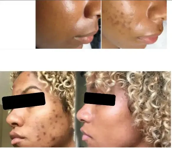 A collage of four close-up photos showing the face of a person before and after skincare treatment, highlighting a reduction in skin pigmentation and acne scars.