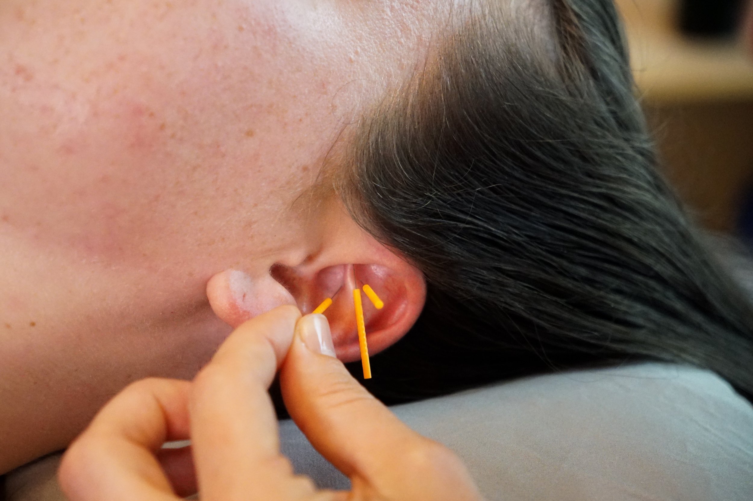 Close-up of a person with dark hair getting an ear acupuncture treatment, with a practitioner inserting a thin acupuncture needle into the person's ear.