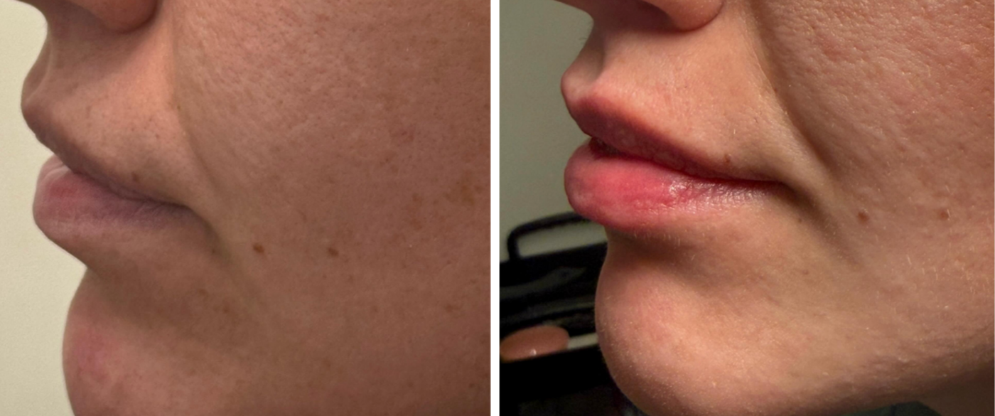Close-up side profiles of a person's face before and after skin treatment, showing improved skin texture and reduced blemishes.