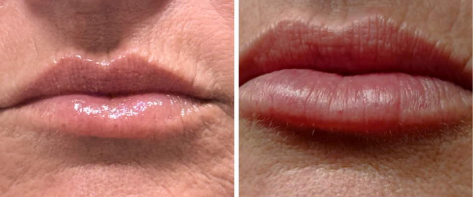 Close-up of lips before and after cosmetic treatment, showing transformation from wrinkled to smooth, fuller lips.