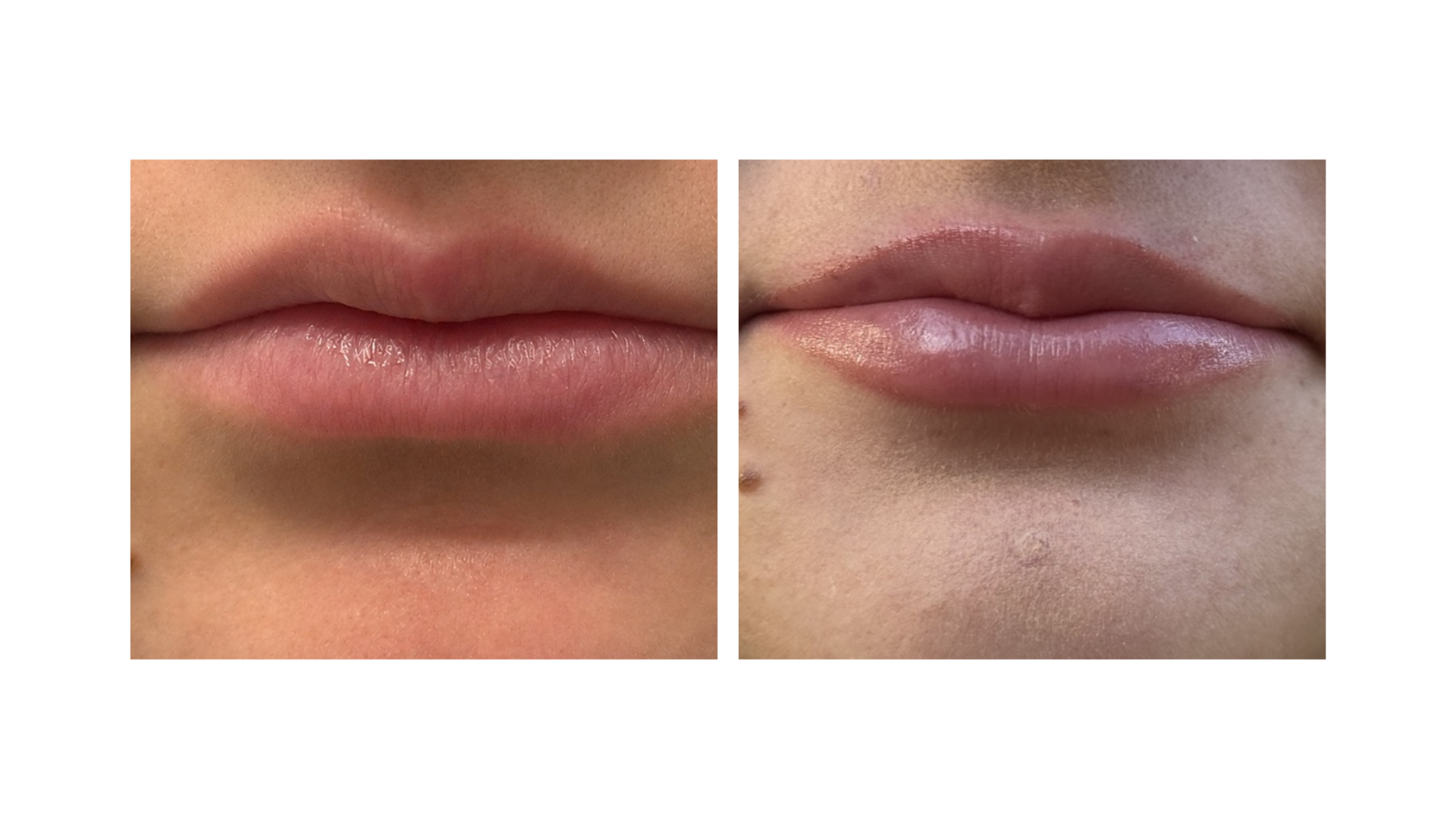 Comparison of lips before and after cosmetic enhancement, with smoother, more defined lips in the after image