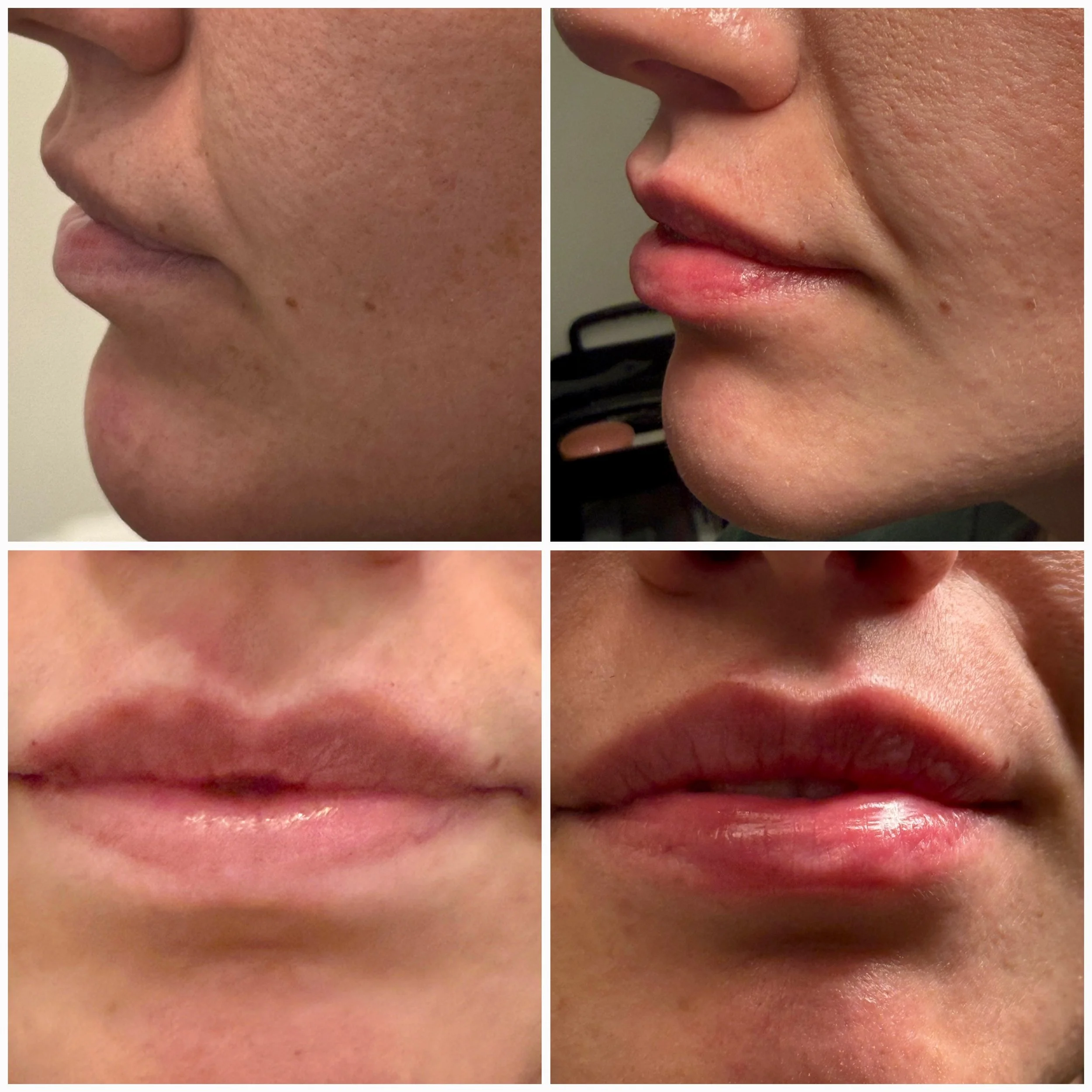 Close-up of a person's face with skin imperfections on the left side and clear, smooth skin on the right side.