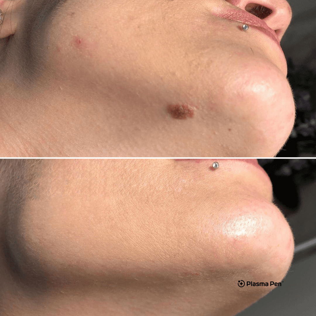 Plasma Pen Mole removal