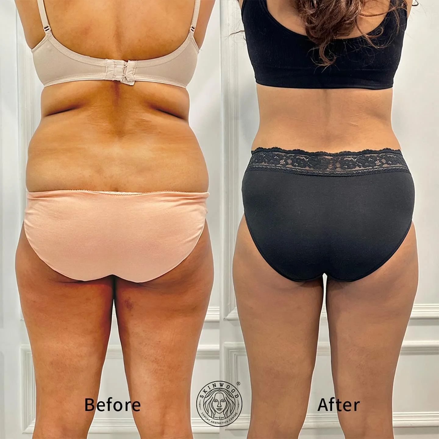 Before-and-after treatment results following Emerald Laser Therapy, showing visible changes to the back and waist area.