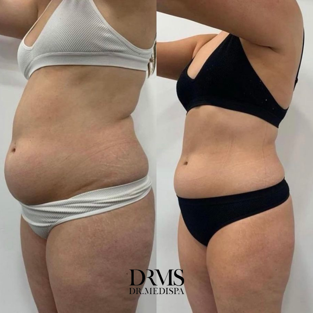 Before-and-after torso comparison following Emerald Laser Therapy, showing a slimmer waistline and visible reduction in the abdominal area.