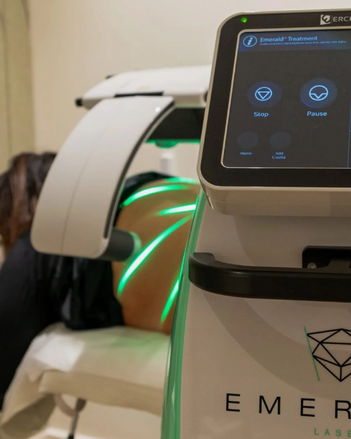 A laser treatment machine with a digital control panel displaying options like stop and pause, emitting green laser beams onto a patient's arm during a cosmetic procedure.
