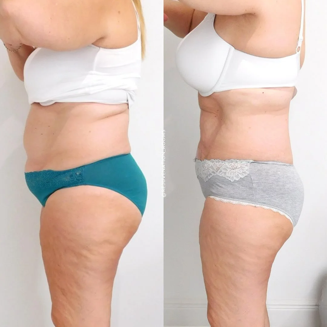 Before-and-after body comparison following Emerald Laser Therapy, showing visible reduction in abdominal and thigh areas.