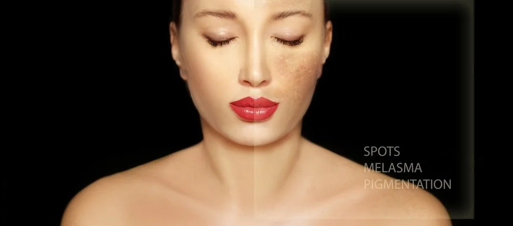 Here’s What Could Be Causing Hyperpigmentation On Your Skin