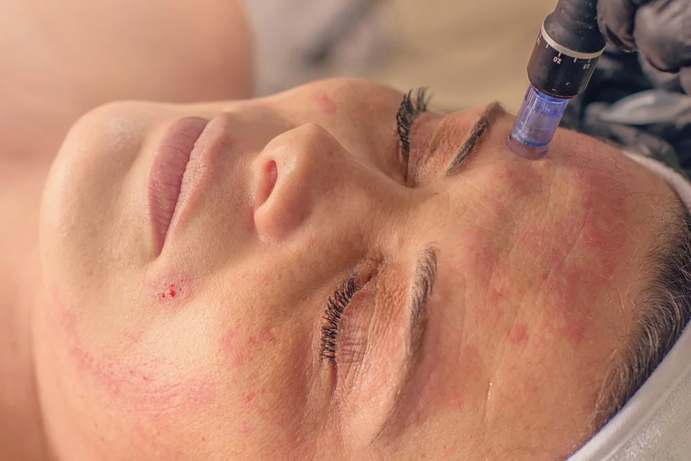 Infini Microneedling Benefits