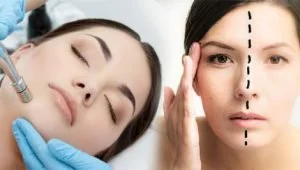 What is Microdermabrasion