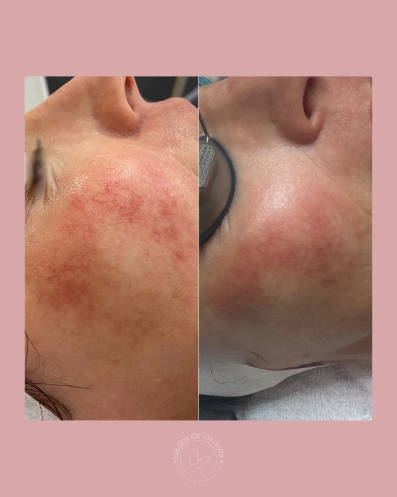 Real results. Real skin. 🤍 

These beautiful results were achieved using the Cutera Excel V+ with Global Matting settings, a precise 532nm wavelength designed to target vascular concerns, calm redness and even out overall skin tone. 

For clients ex