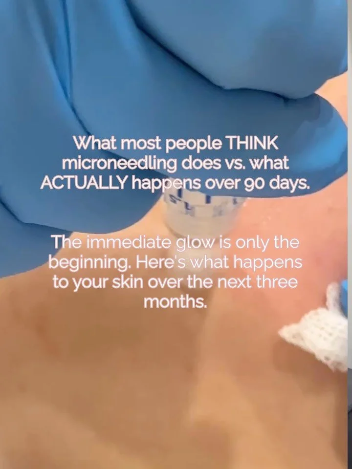 ✨ Microneedling is a process, not an overnight transformation.

One of the biggest misconceptions about microneedling is that the glow you see immediately after treatment is the result.

It isn&rsquo;t.

That initial plumpness and radiance can be inf