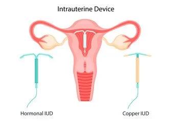 iud.jpg
