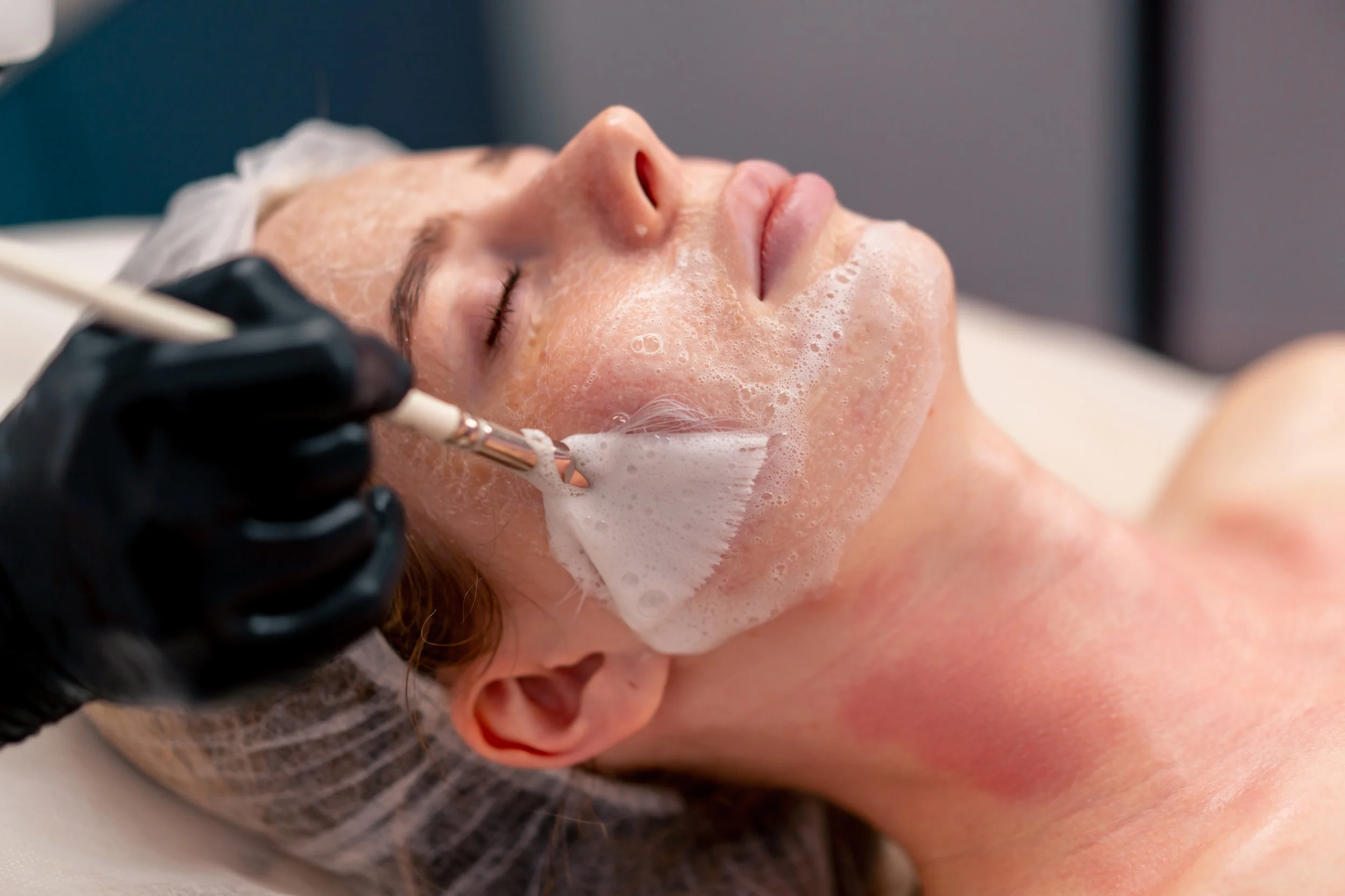 Chemical Peel Treatment in Clifton Park, NY