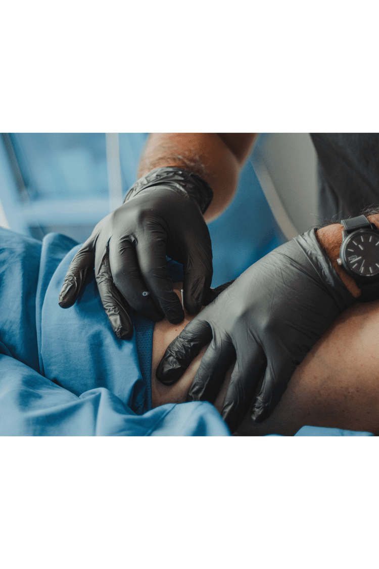 Dry needling treatment