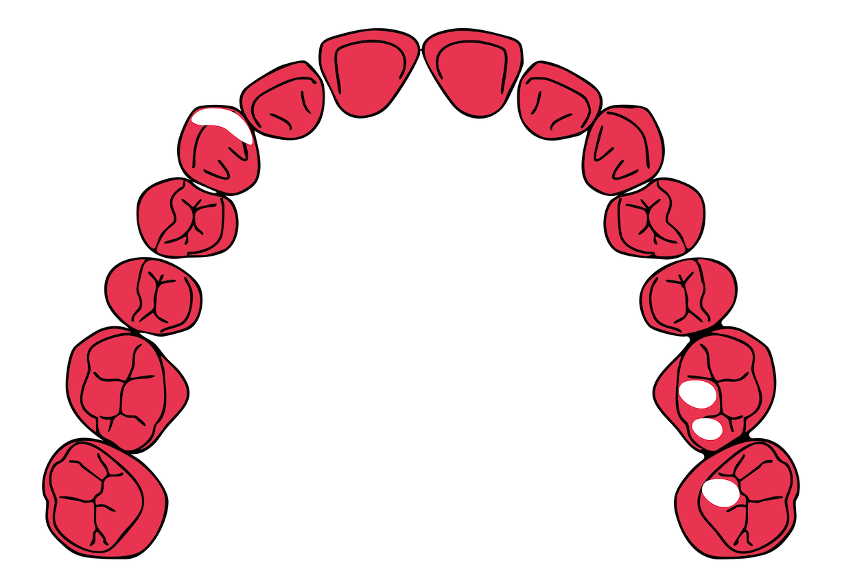 An illustration of a closed human mouth with 16 teeth, shown from a frontal view, against a black background.