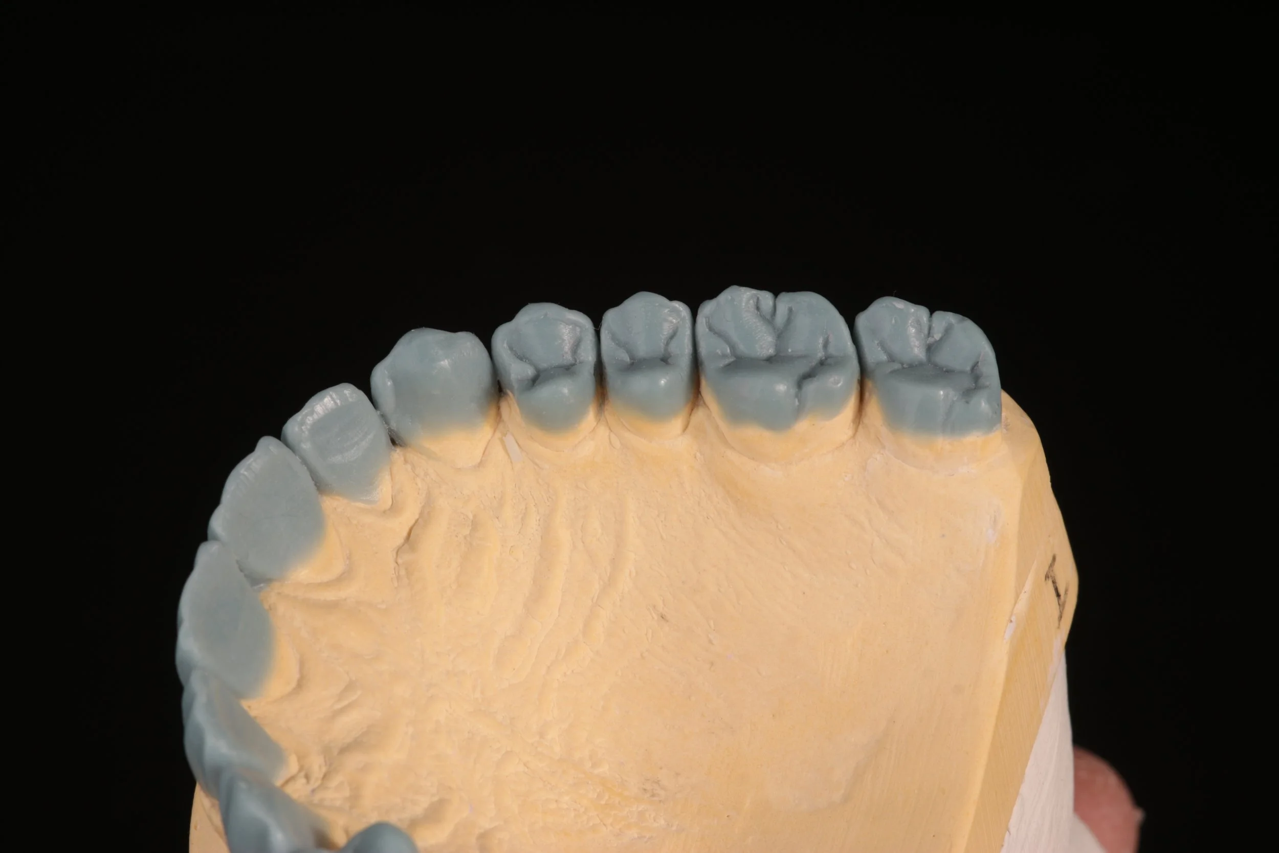 Dental model showing a row of teeth with dental crowns or restorations on the upper teeth.