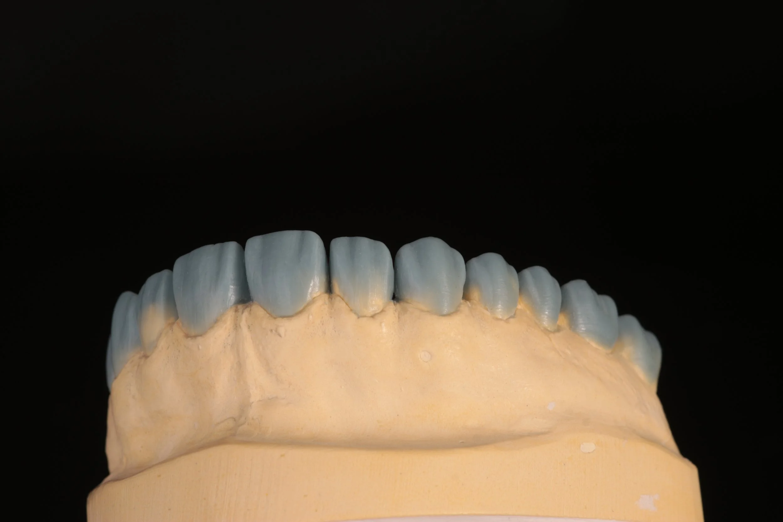 A dental prosthetic model showing a set of upper teeth, with some teeth appearing to be made of a different material, set on a beige base against a black background.