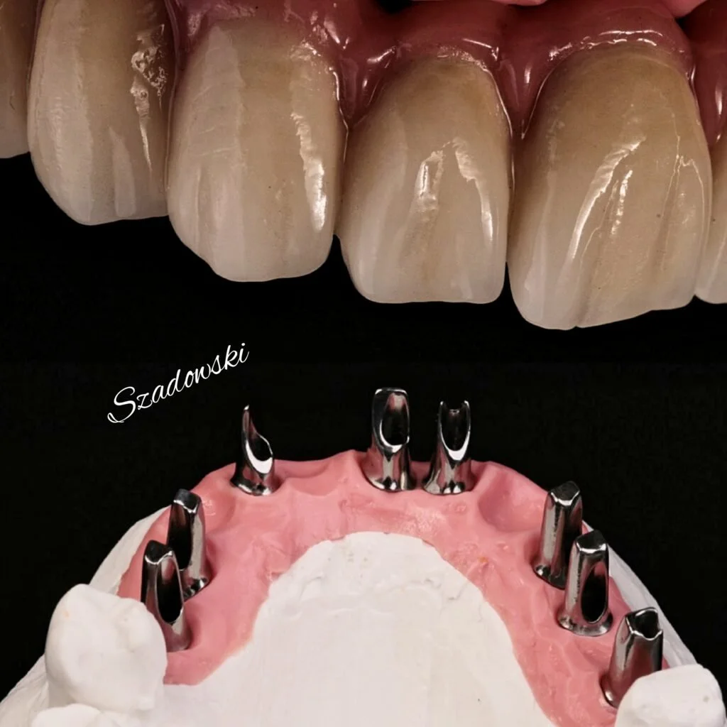 Close-up of upper teeth with dental implants. The lower part shows a dental implant model with metal abutments in place for restoring missing teeth.