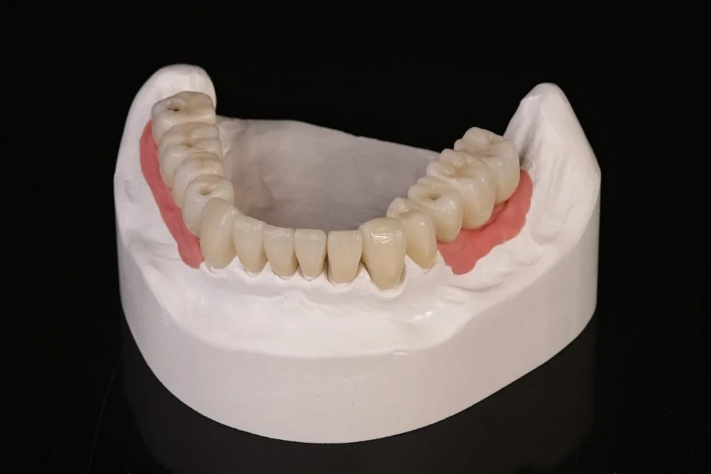 Dental model with a full set of lower teeth, including molars and incisors, on a black background.