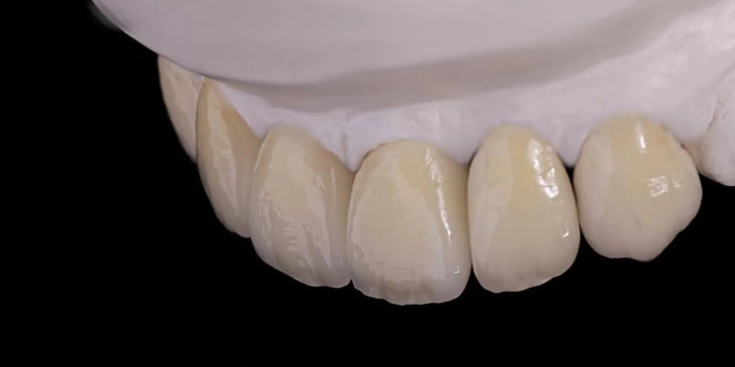 Close-up of a dental model showing the upper row of teeth with white gums, set against a black background.