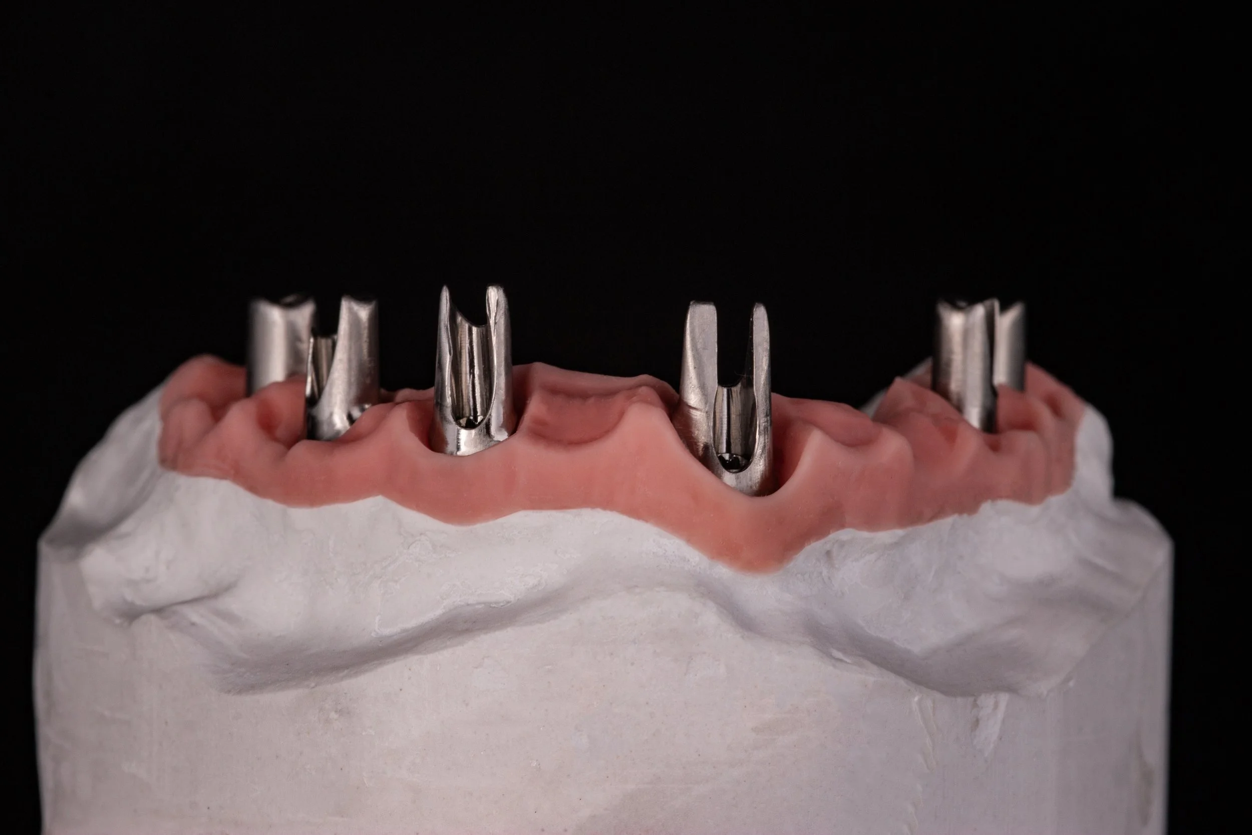 Close-up of an upper human jaw with five metal dental implants embedded in the gums against a black background.