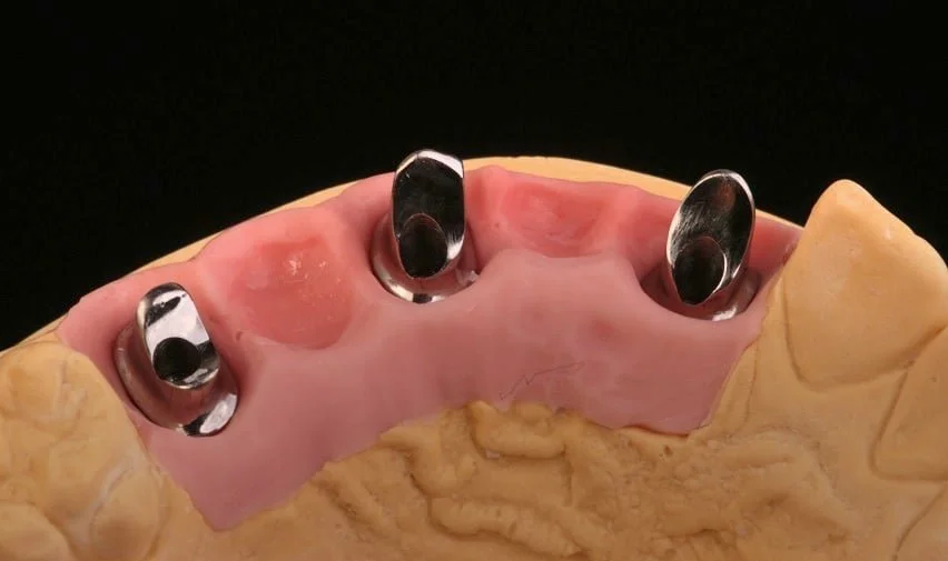 Model of a mouth with pink gums and yellow teeth, fitted with four shiny metal dental implants or abutments.