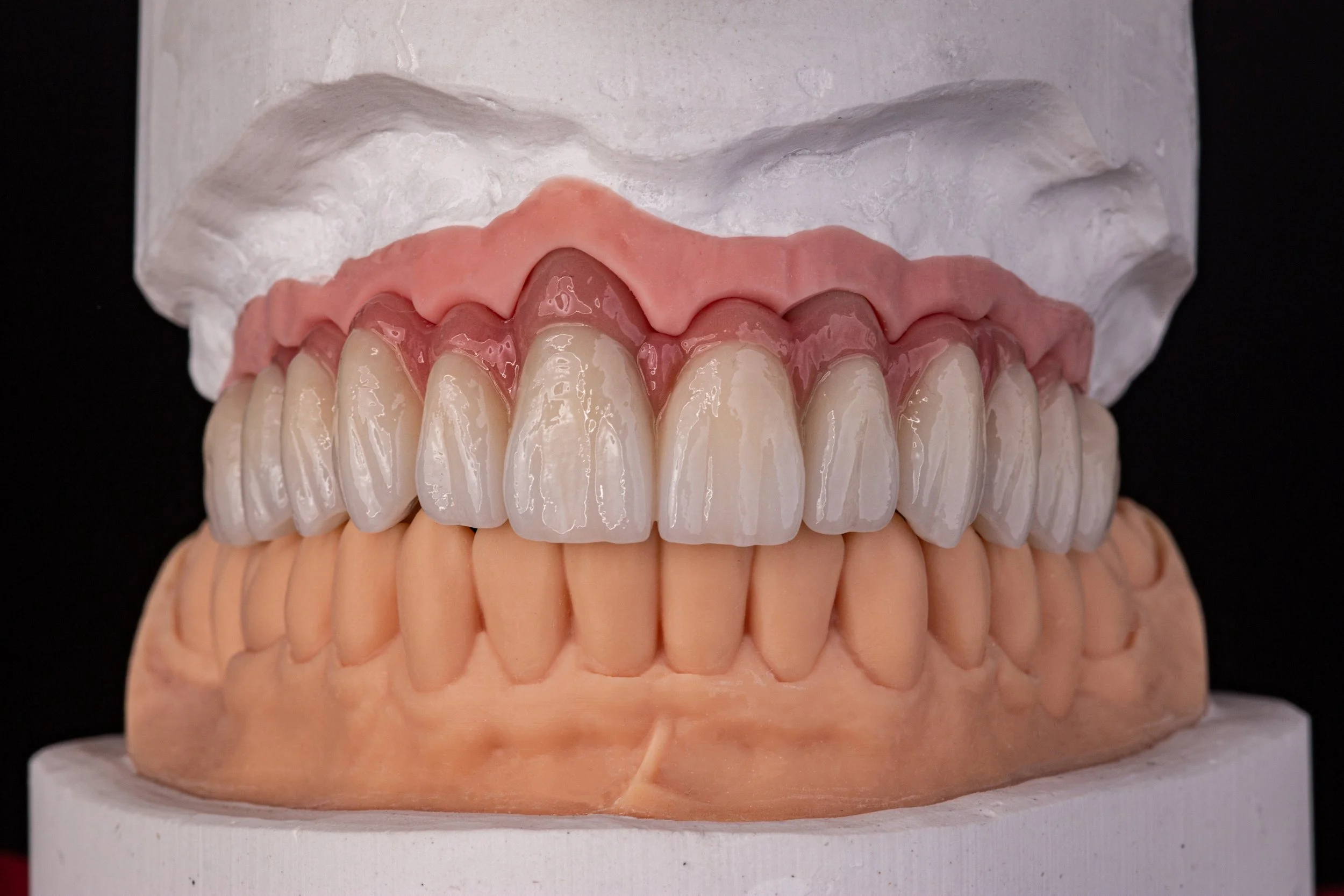 A dental model showing upper and lower teeth with pink gum section and white teeth, mounted on a white base against a black background.