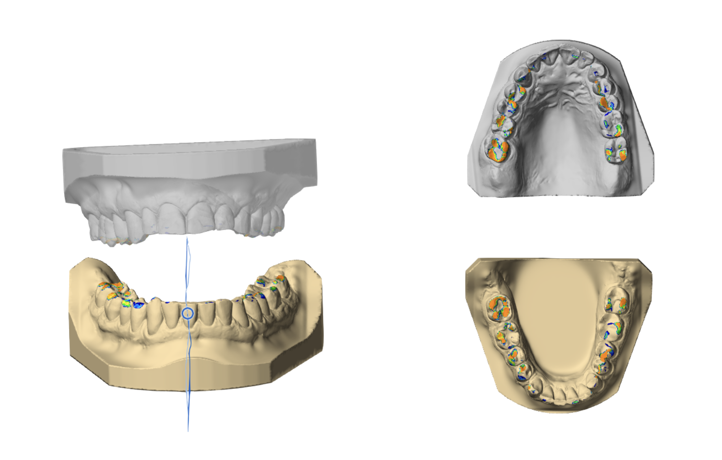 3D dental models showing the upper and lower teeth and gums with colored markers indicating areas of interest for dental analysis.