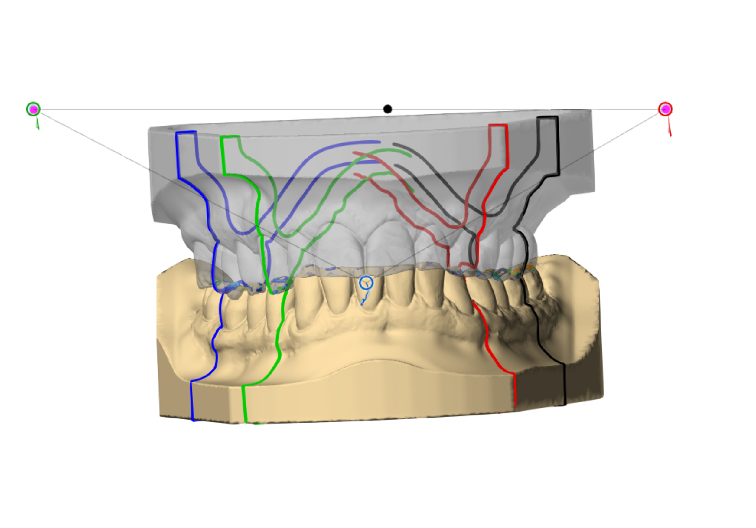 3D model of human teeth and jaw bones with colored lines and paths indicating dental nerve and blood vessel routes for dental procedures.