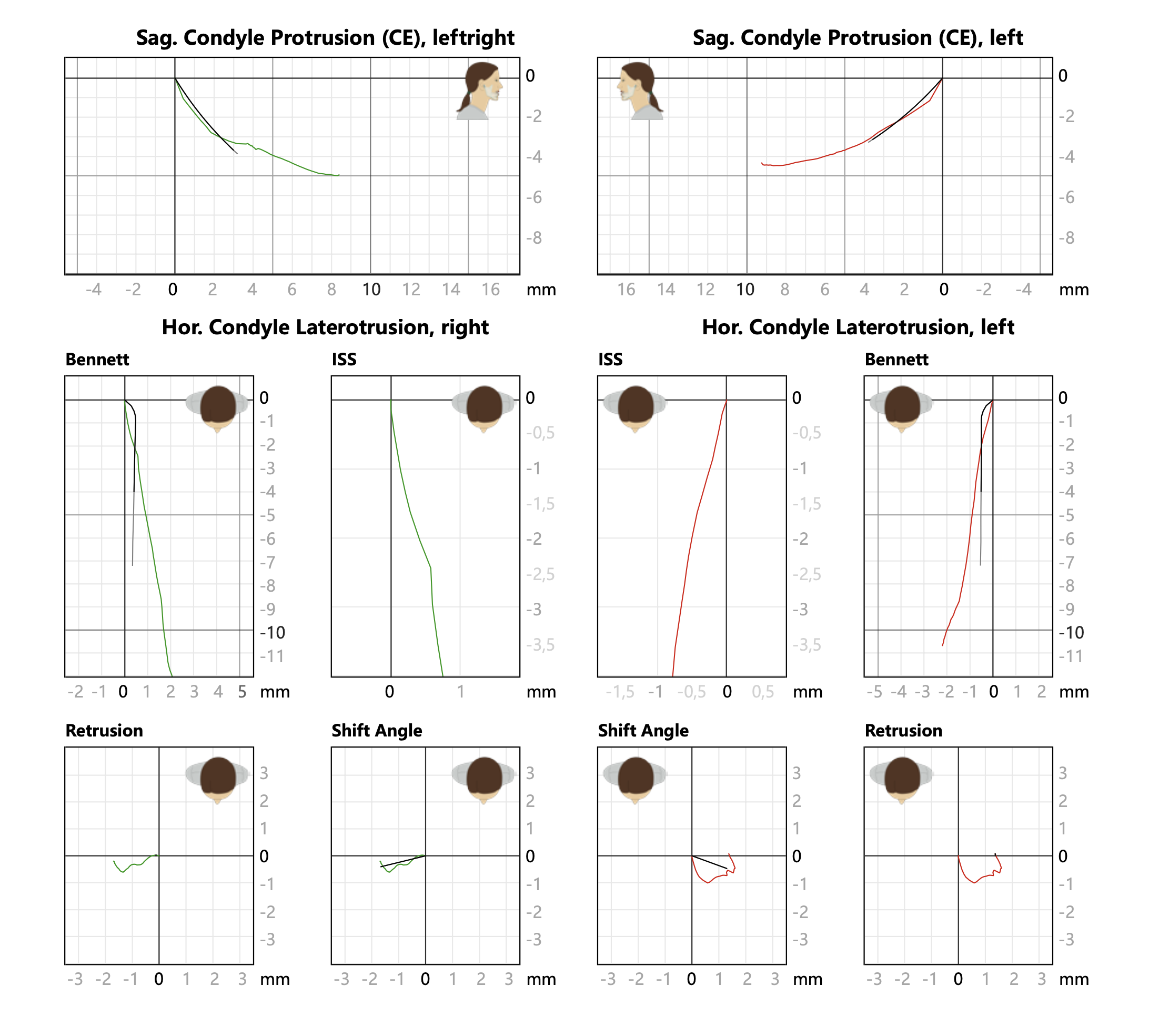 Charts showing sagittal and horizontal condyle protrusion and lateralization measurements on three different patients, with patient illustrations and axis labels in millimeters.