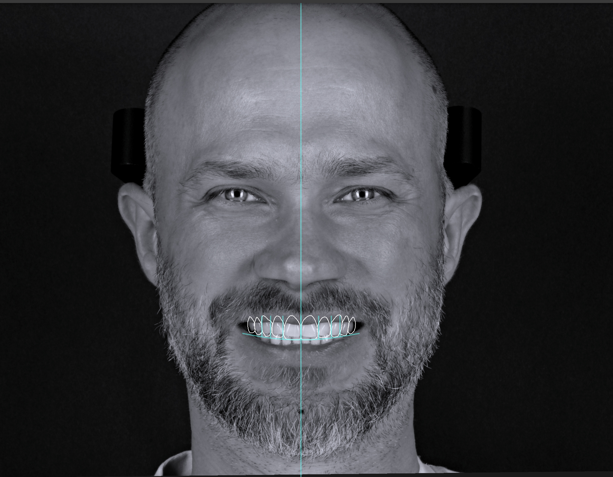 Black-and-white image of a smiling man with light skin, short hair, and a beard. He is looking directly at the camera, with a neutral background and some facial markings and annotations overlaid on the image.