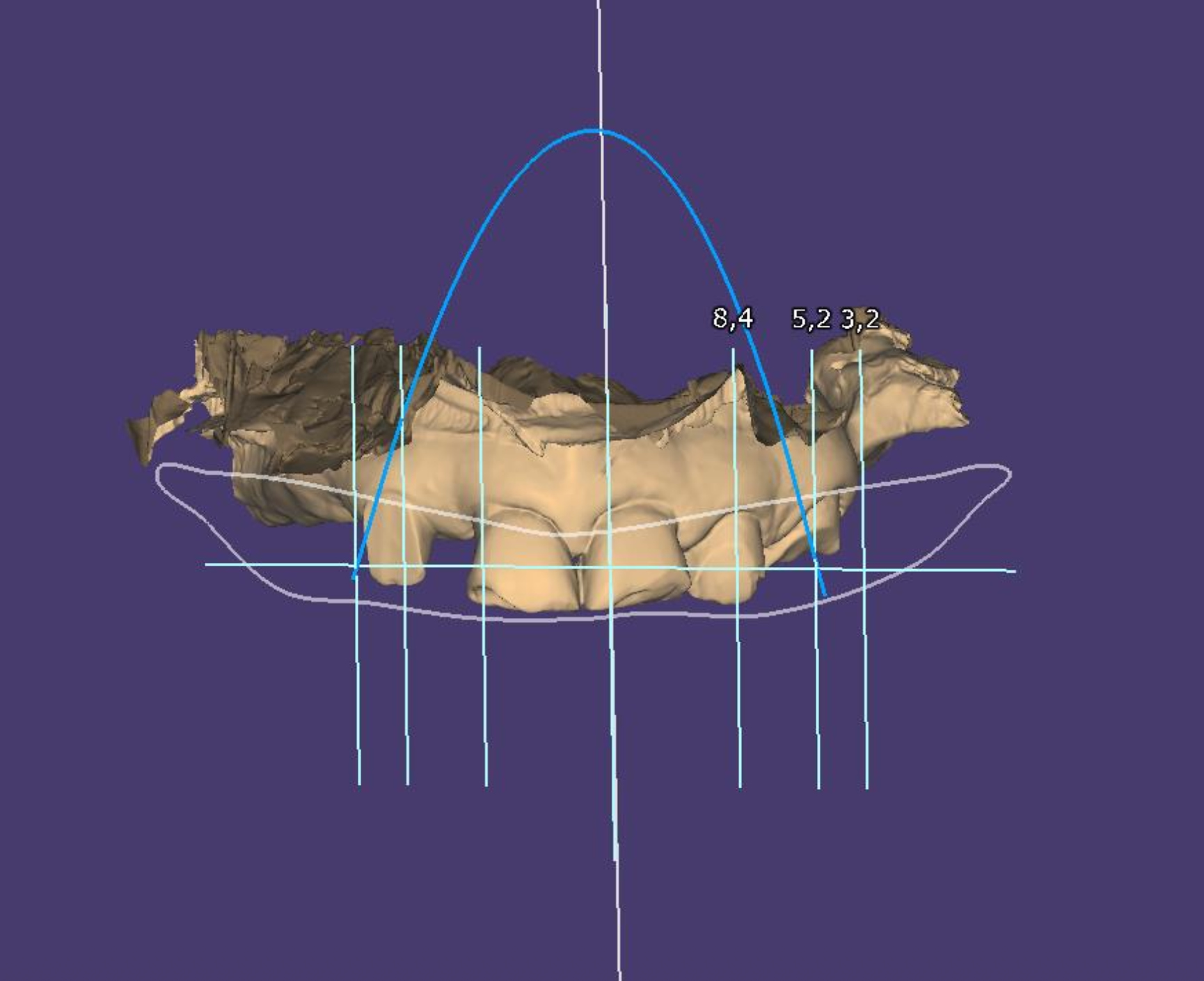 A 3D digital model of a human jawbone with measurement lines and data points overlaid, set against a purple background.