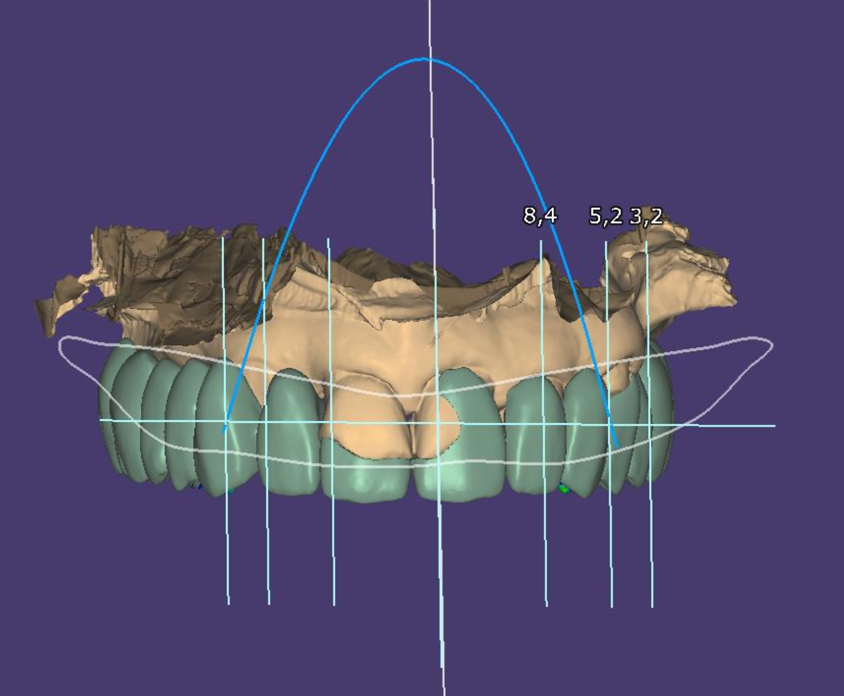 Digital dental model of a human upper jaw with teeth, measurements, and a 3D graph overlay.