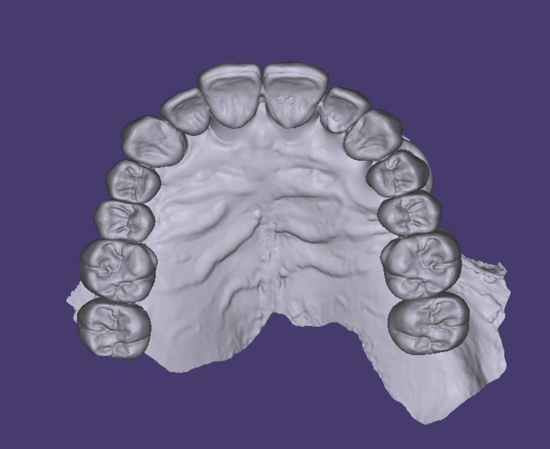 Digital 3D scan of a human upper jaw showing teeth and palate against a purple background.
