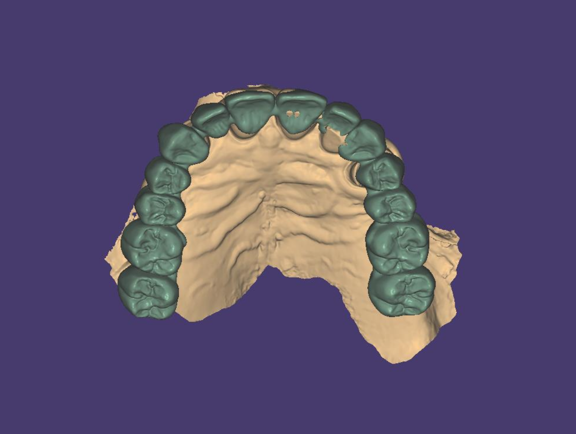 Digital 3D model of a dental impression showing the upper teeth and palate, with a section of the jaw and skull visible in the background.