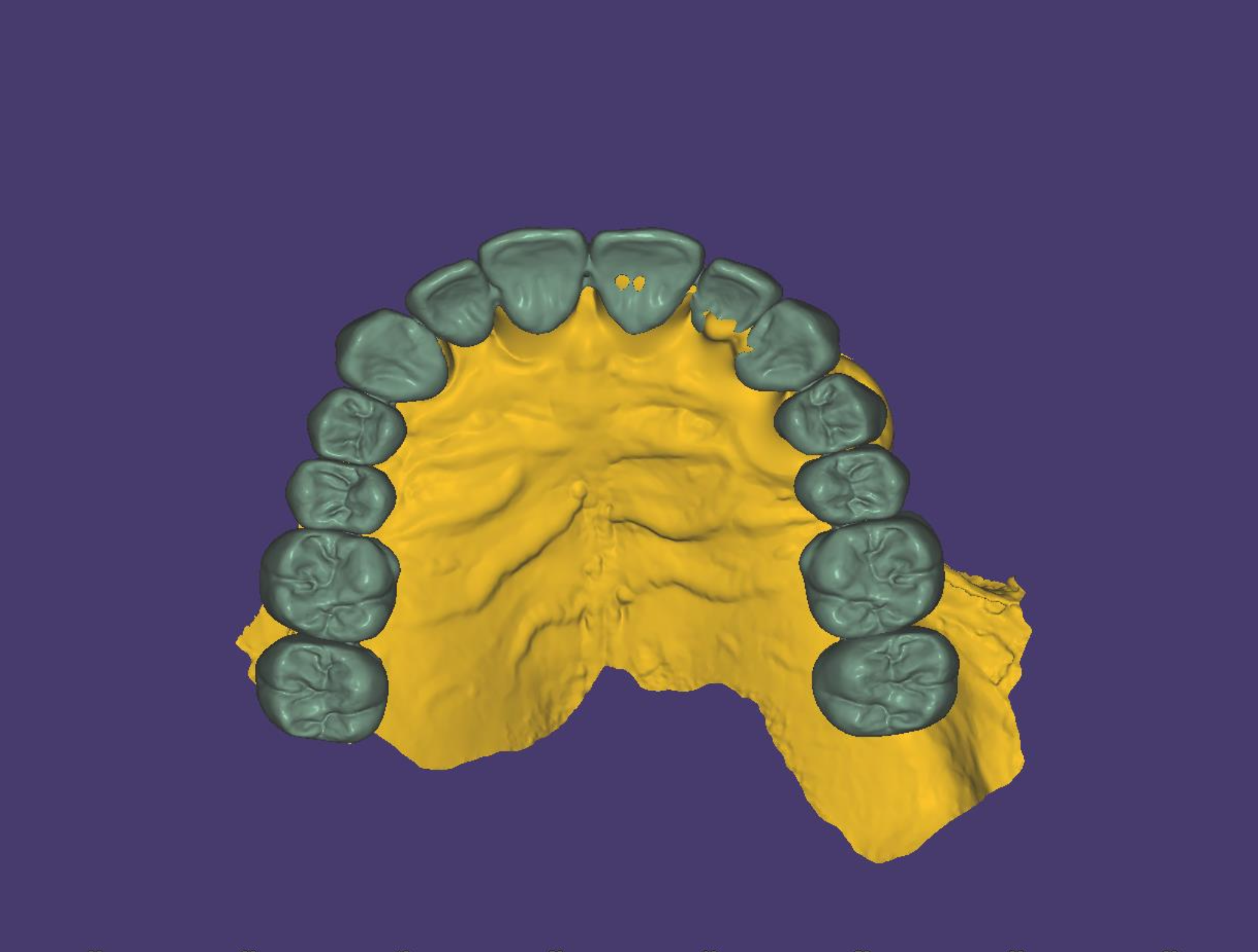 3D digital model of a human palate with teeth, seen from above, colored in shades of green and yellow on a purple background.