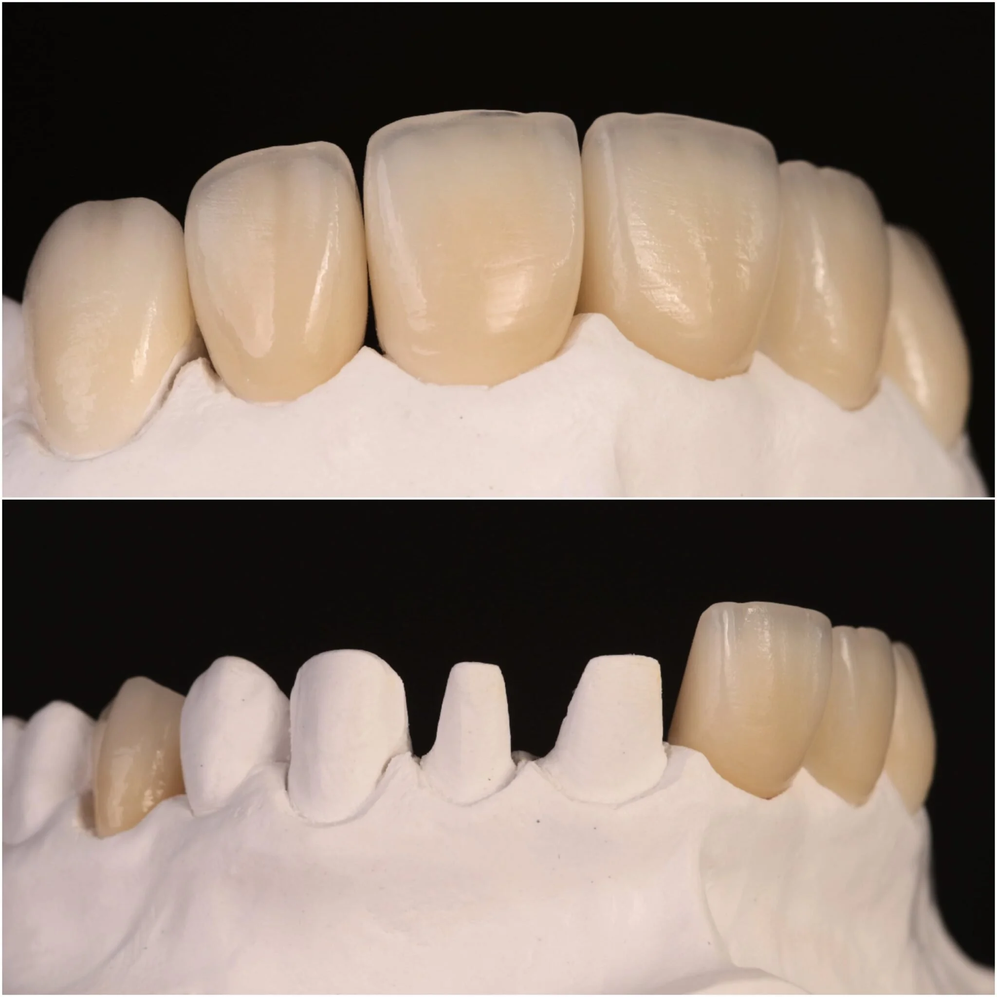 Close-up of a set of dental crowns on a dental model against a black background.