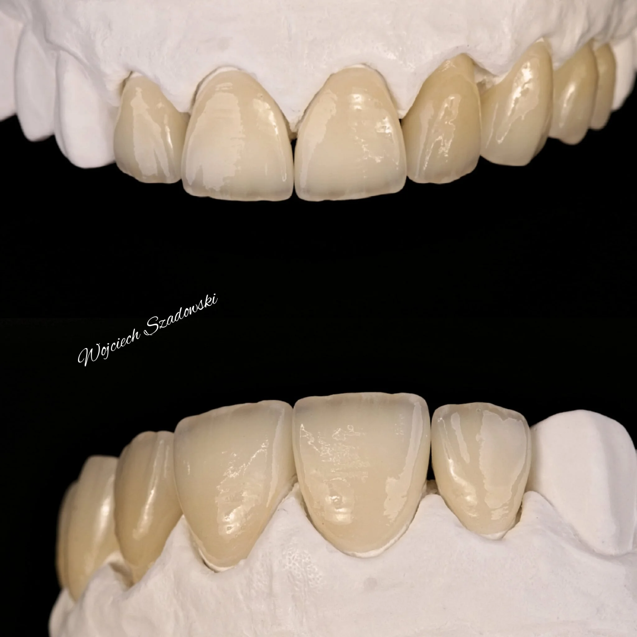 A close-up of artificial teeth on a dental model, showing the front teeth and their arrangement.