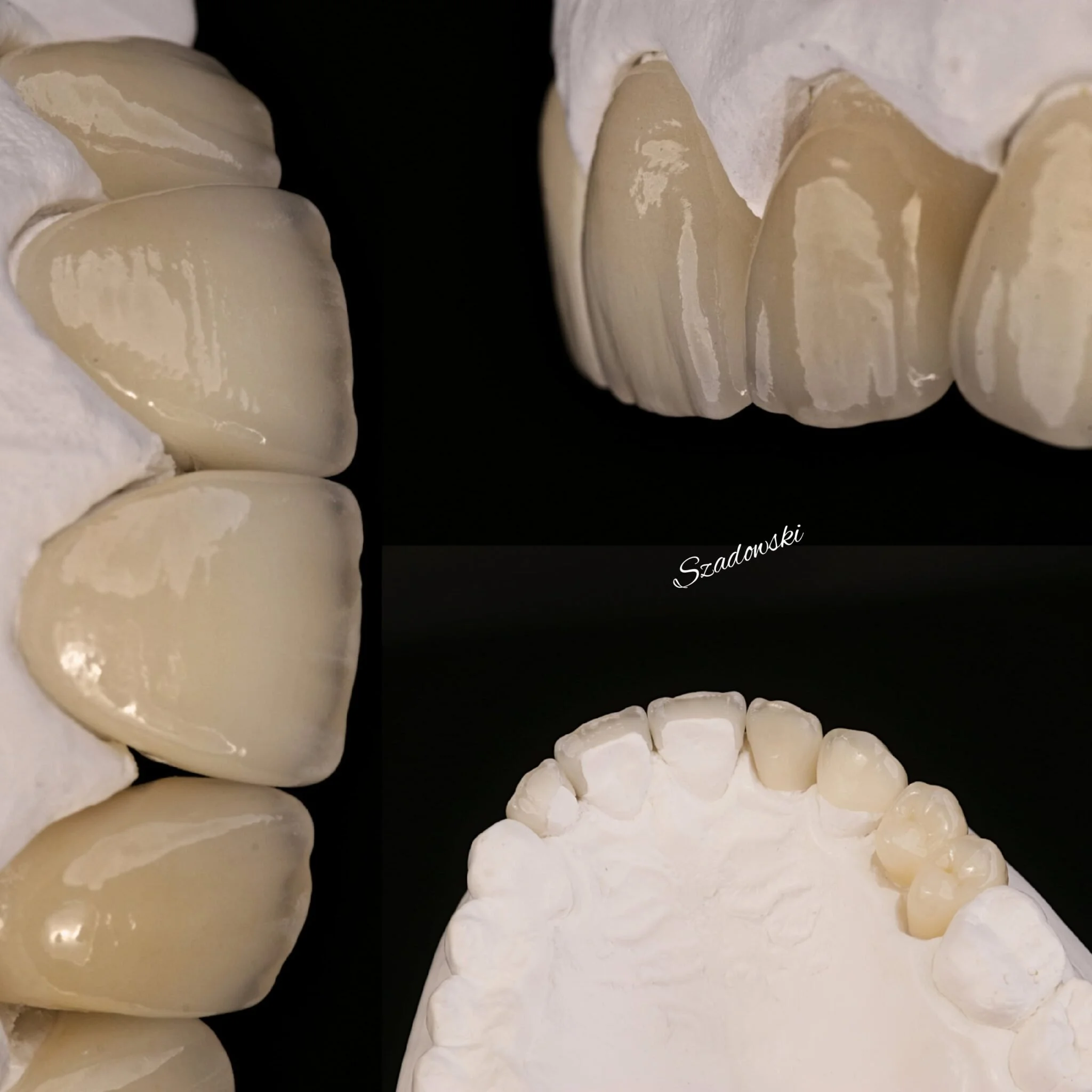 Close-up of pairs of human teeth with one set showing teeth from a top view and the other from a bottom view, against a black background.