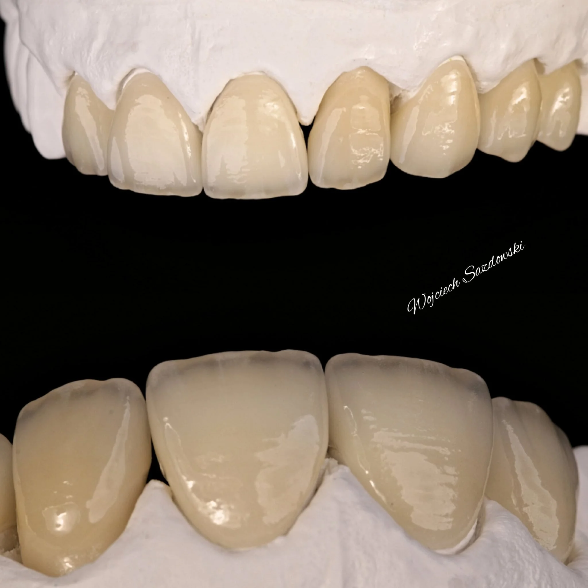 Close-up of a dental model showing upper front teeth, some of which are dental crowns or veneers.
