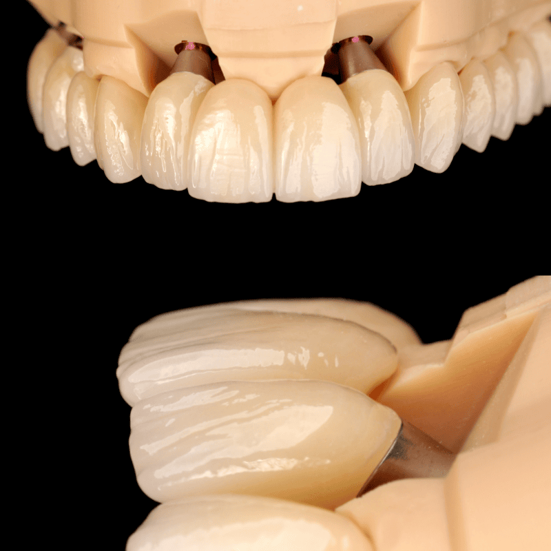 A dental model showing dental implants and a set of artificial teeth in the upper and lower jaw.