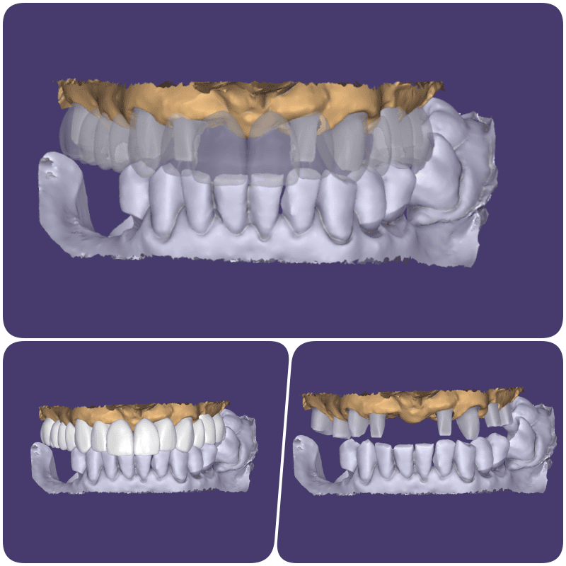 3D digital scans of a human dental arch showing upper and lower teeth from different angles