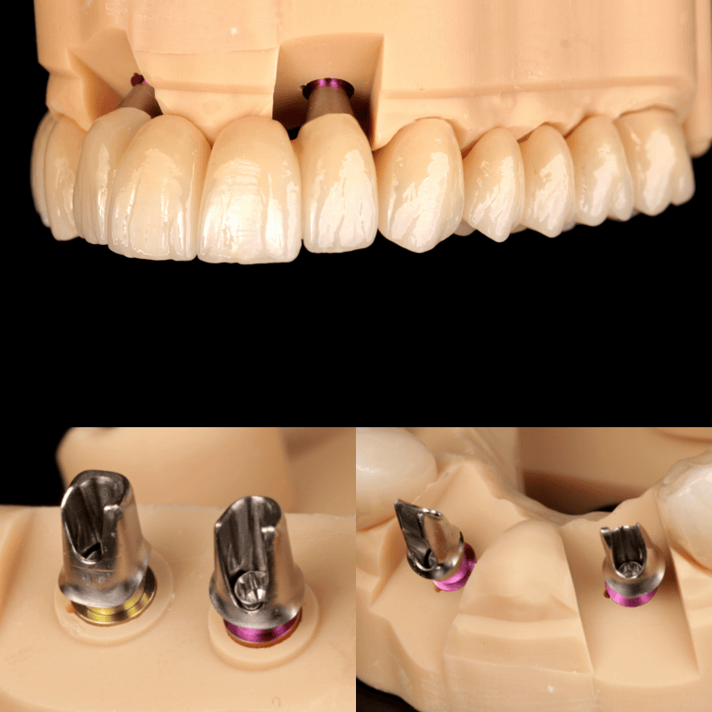 Dental implant models showing artificial teeth and implant abutments in a dental laboratory setting.