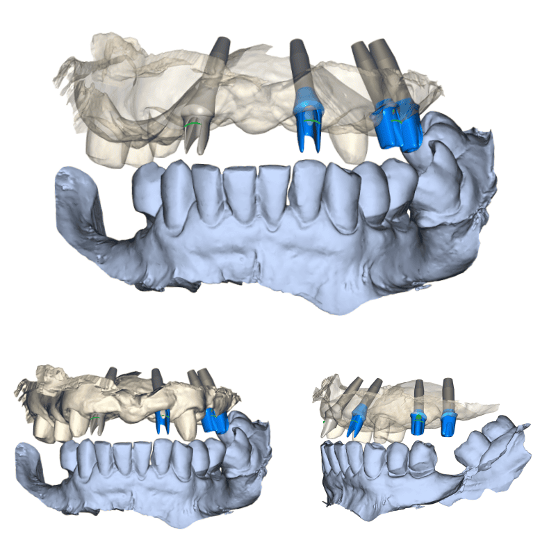 3D digital models of a human jaw with dental implants and crown restorations, showing top, front, and side views.
